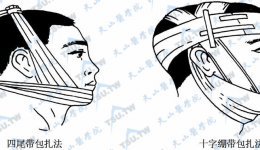 上下颌骨骨折手术护理