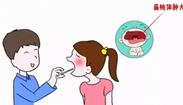扁桃体炎护理
