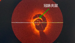 开启介入精准治疗时代！我院成功完成崇左市首例OCT应用指导冠脉介入治疗