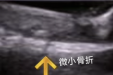 孕期摔倒不用做CT，崇左市人民医院肌骨超声技术精准护母婴！