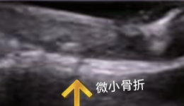 孕期摔倒不用做CT，崇左市人民医院肌骨超声技术精准护母婴！